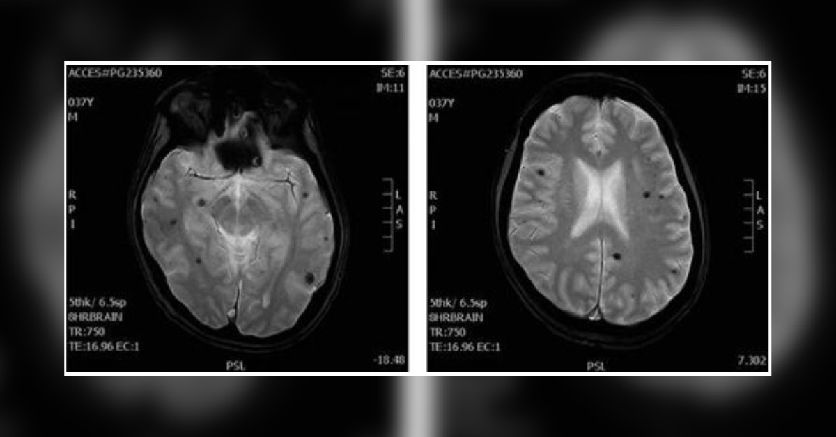 Identify The Condition Characterized By Increased WBCs And Dark Spots In The Brain