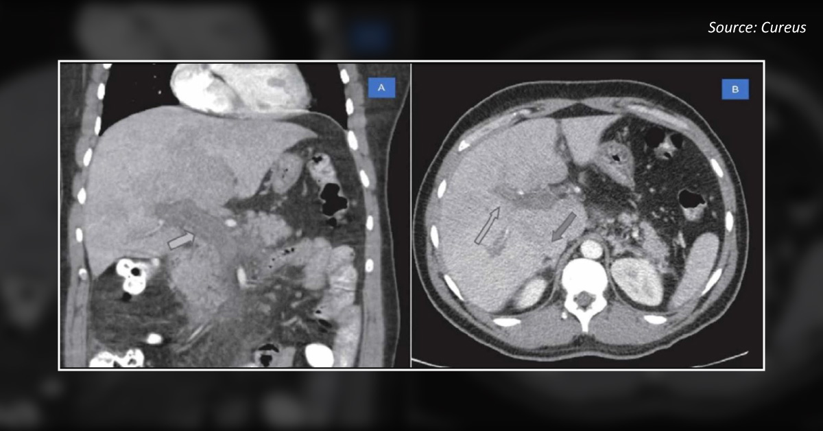 A Male With Generalized Fatigue And Diffuse Abdominal Pain