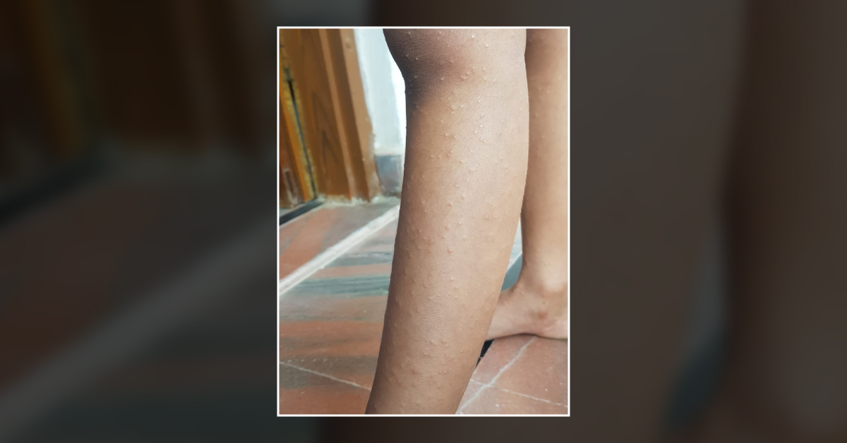 Child With Mild Itching And Pin Point Rashess