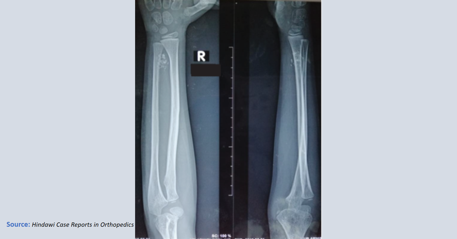 A Rare Orthopedic Case Study with a Diagnostic Challenge