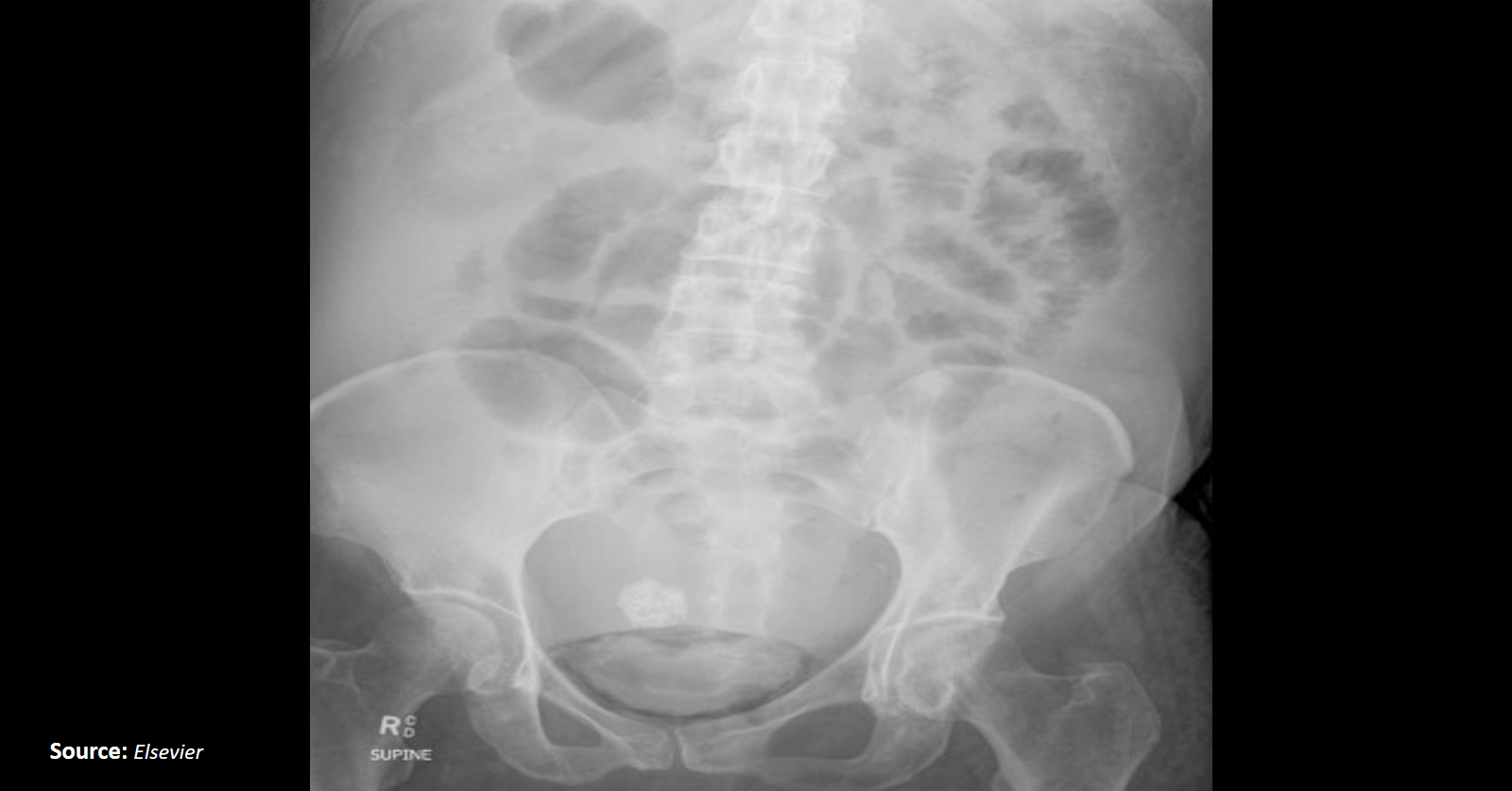 An Elderly Female With Generalized Abdominal Tenderness Following Ascetic Tap