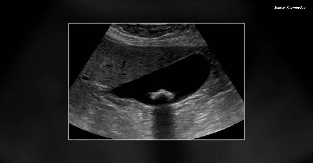 What's Causing Upper Right Quadrant Pain in This Woman?