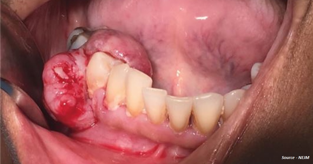 Diagnose This Case of Severe Gingival Swelling in an Old Woman