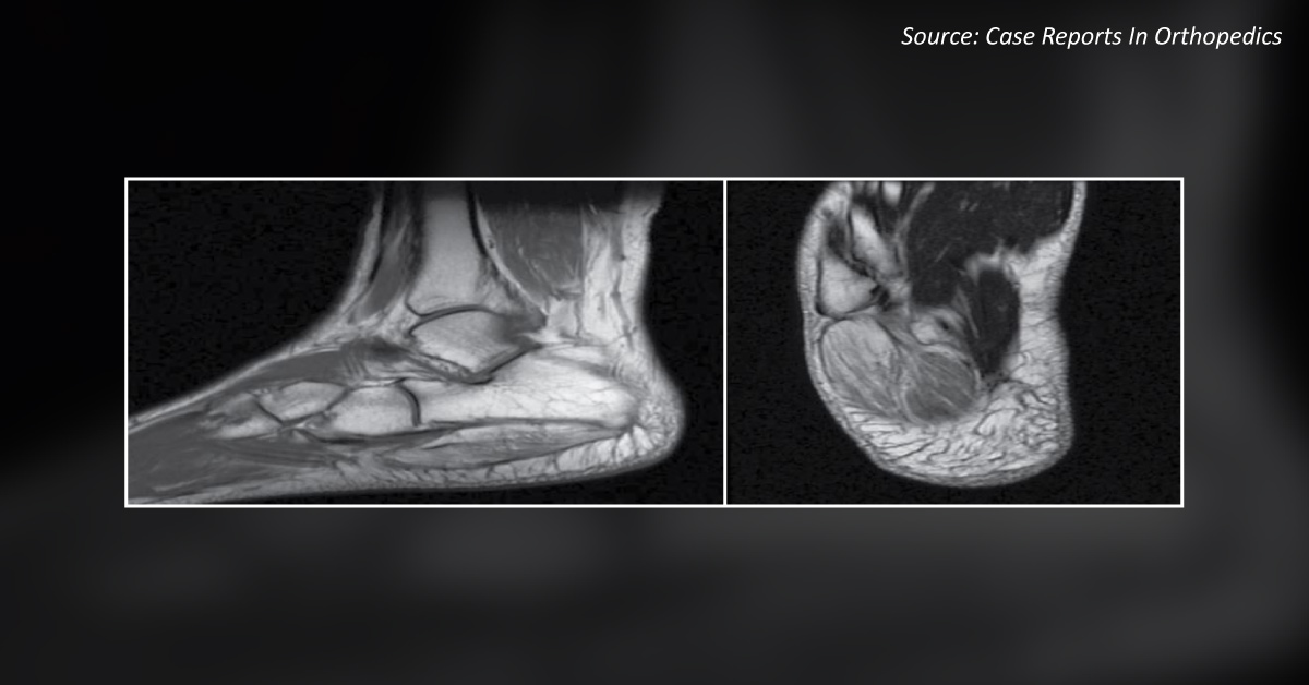 What Could Be the Cause of Foot Pain in This Patient?