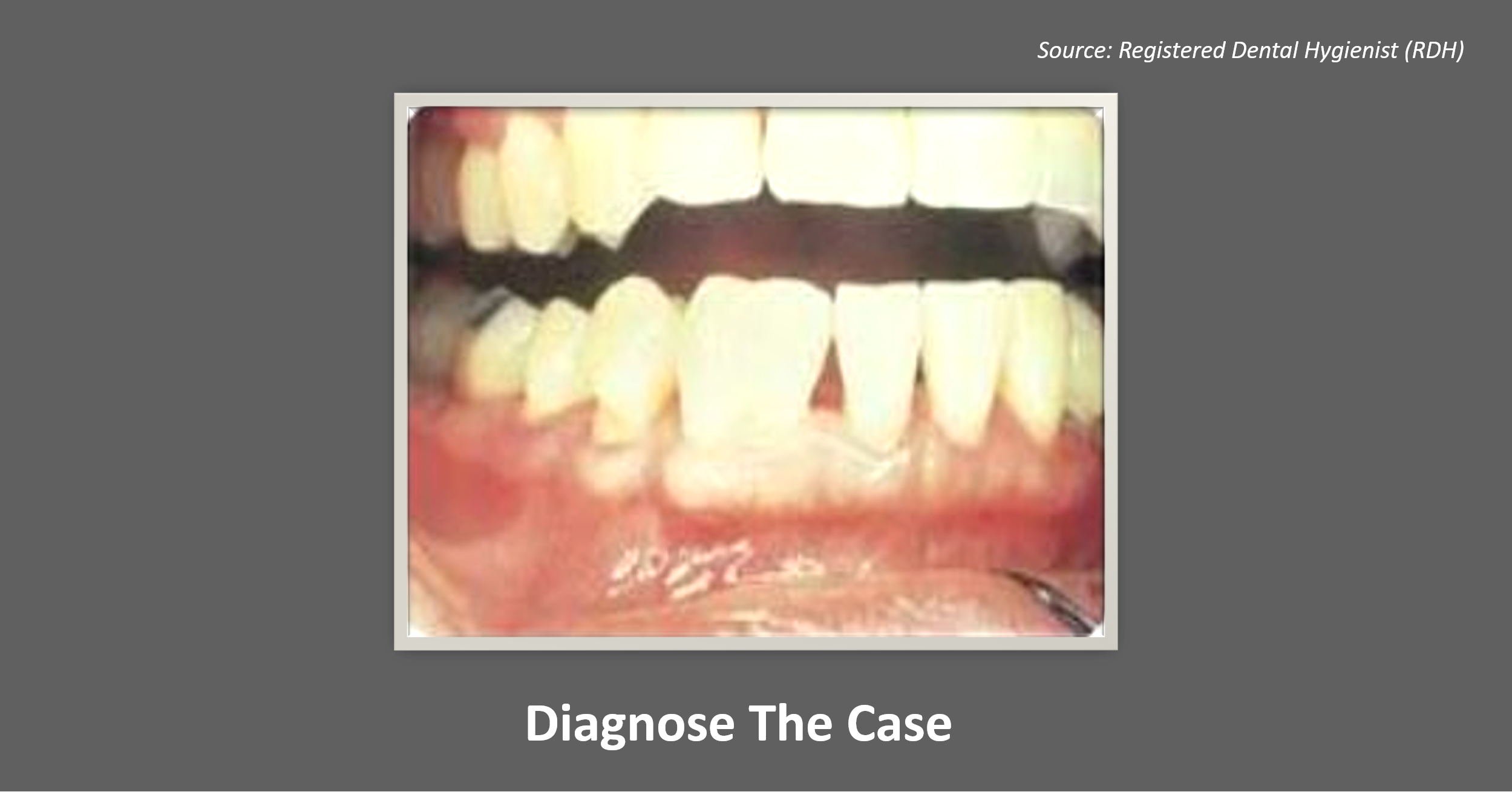 Identify the Cause of the Misshapen Mandibular Tooth