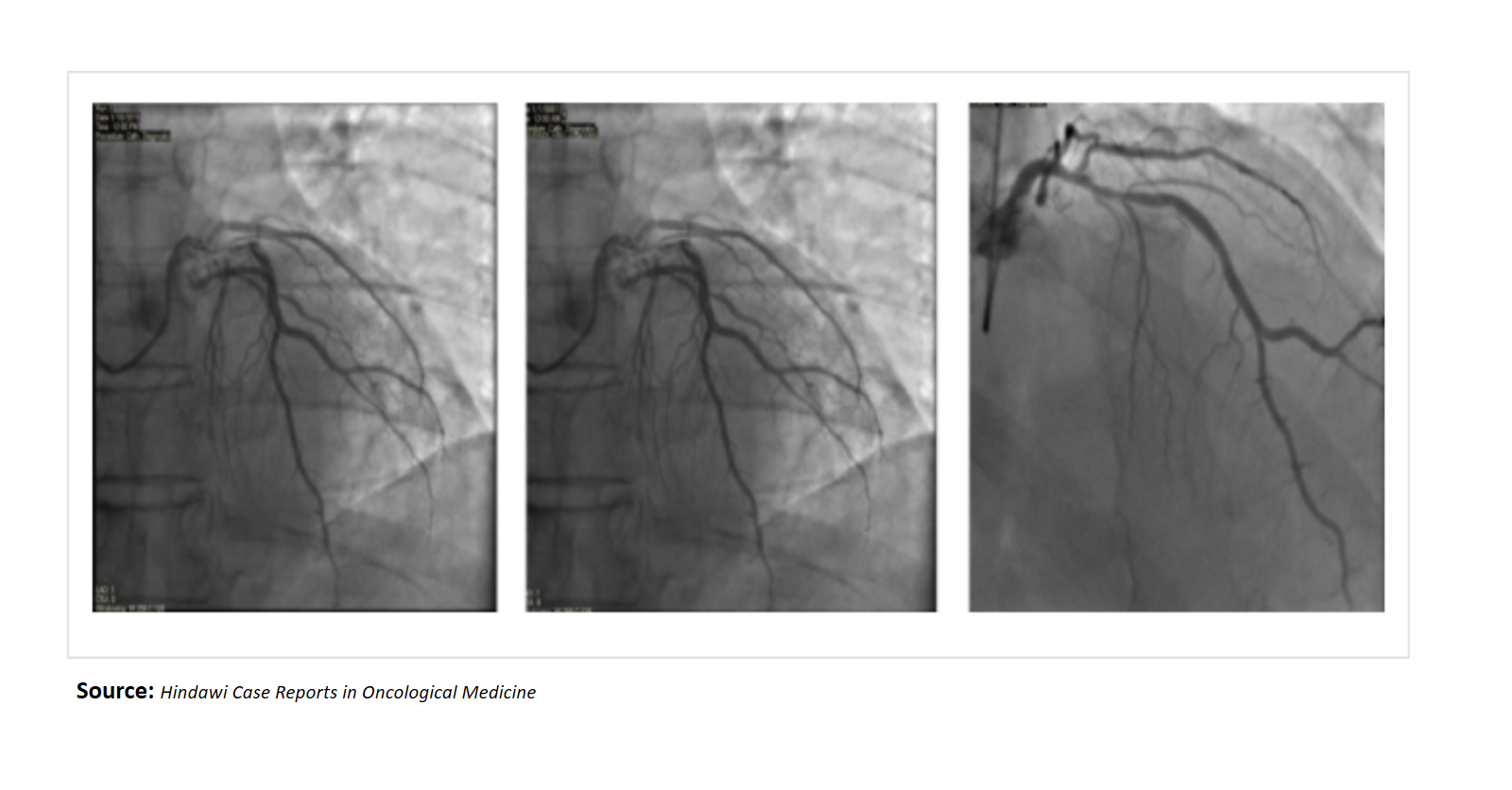 A Rare Oncology Case With Diagnostic Challenge