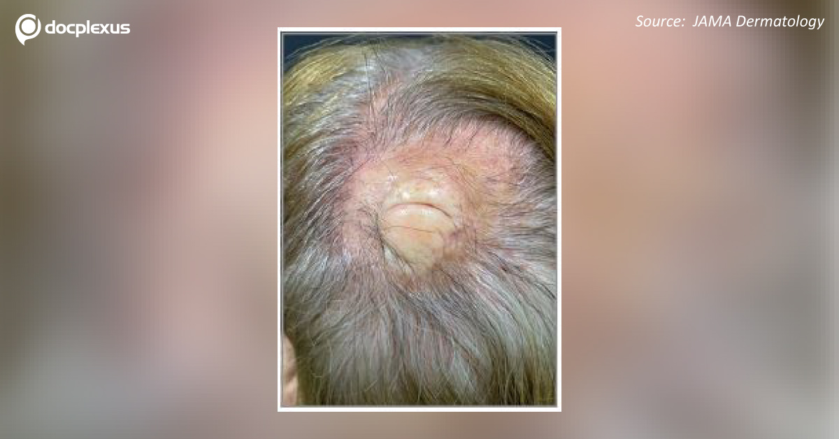 Diagnose The Case Of Congenital Scalp Lump