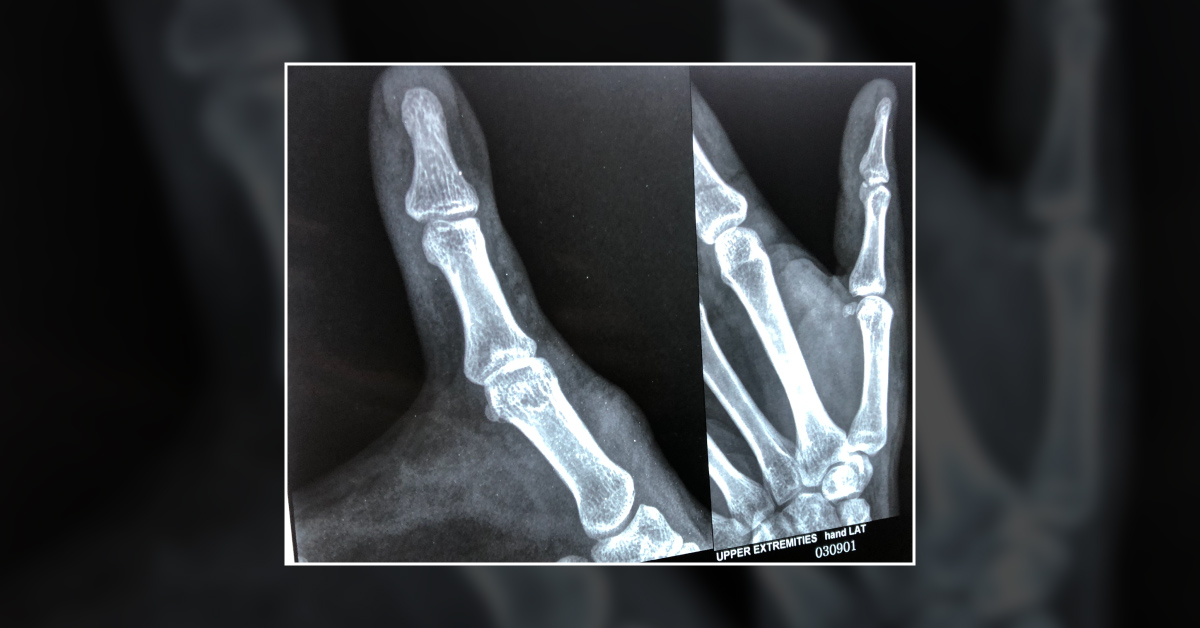 Management Of 45 Days Old Chip Of Distal Phalanges Suspected