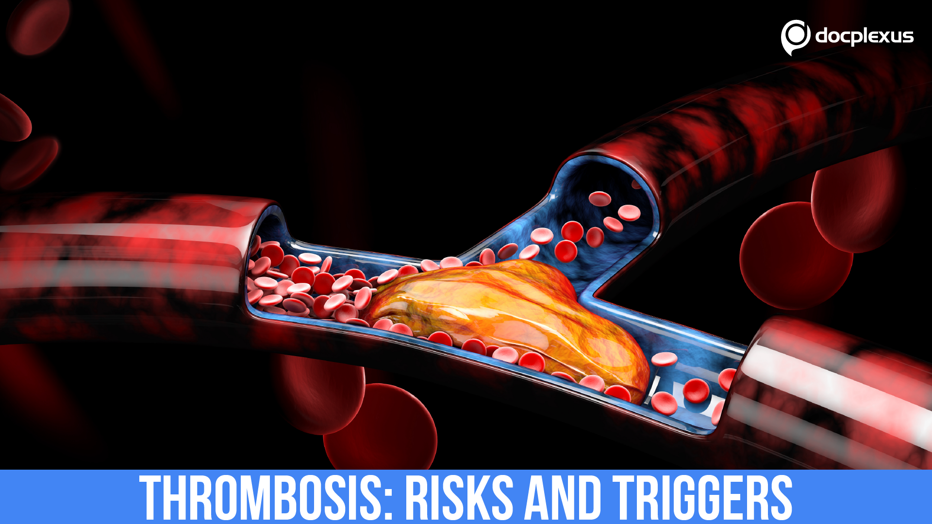 Eyes Open To Thrombosis, Risks And Triggers