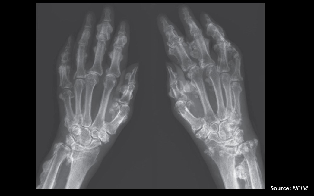 Case of a Woman with Progressive Swelling in Her Hands and Diffuse Body Pain