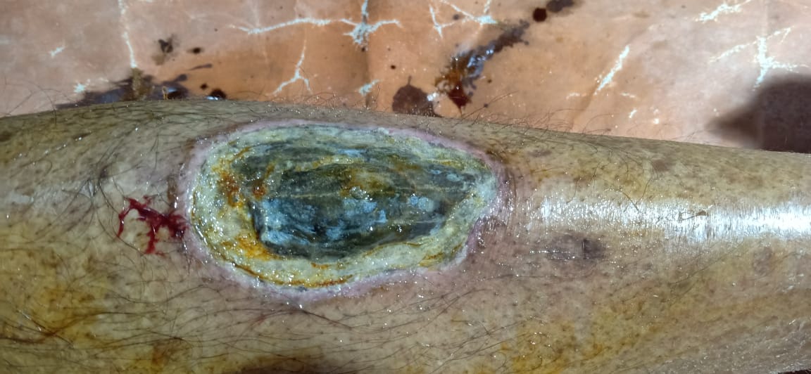 Necrosed Ulcer On Left Leg Of This 67 Yr Old