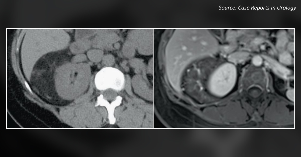 A Middle-aged Woman with an Unusual Tumor in the Retroperitoneum