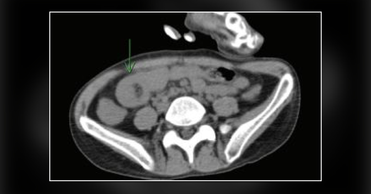 Identify the Cause of the Patient’s Abdominal Pain