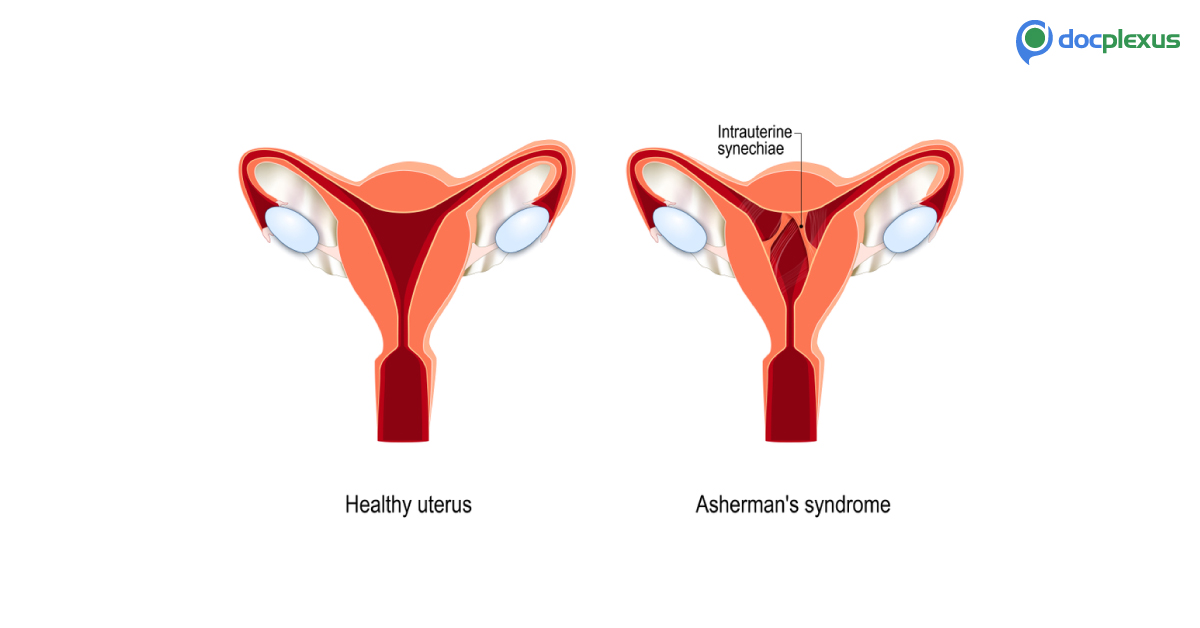 Asherman’s Syndrome
