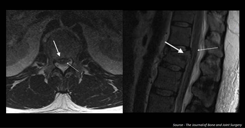 Identify the Neurological Condition in This Patient with Isolated Spinal Injury