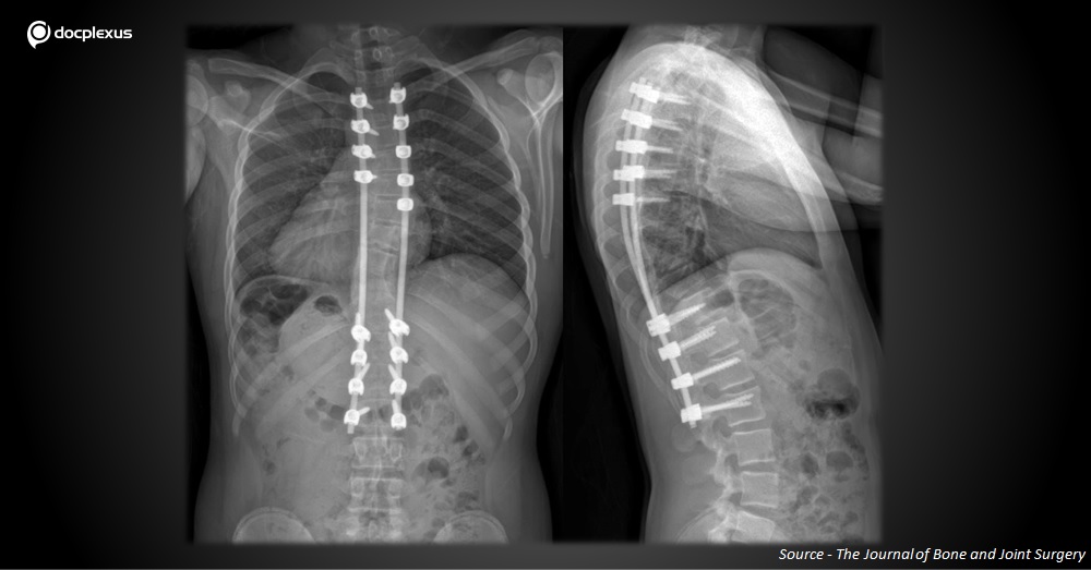 What's Your Diagnosis for This Young Boy with Idiopathic Scoliosis?