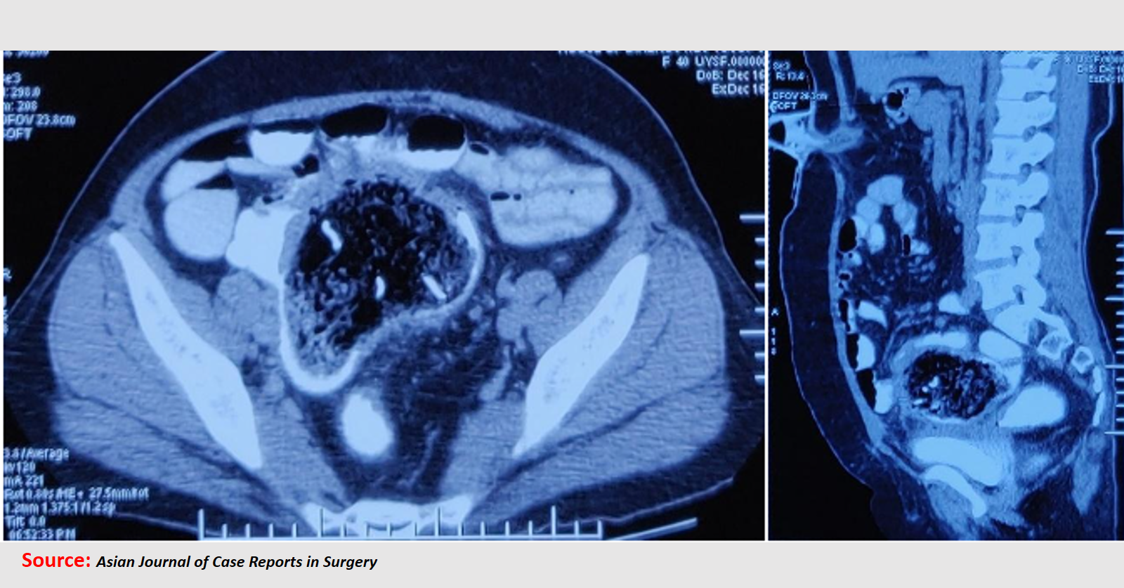 A Case of Rectovaginal Fistula
