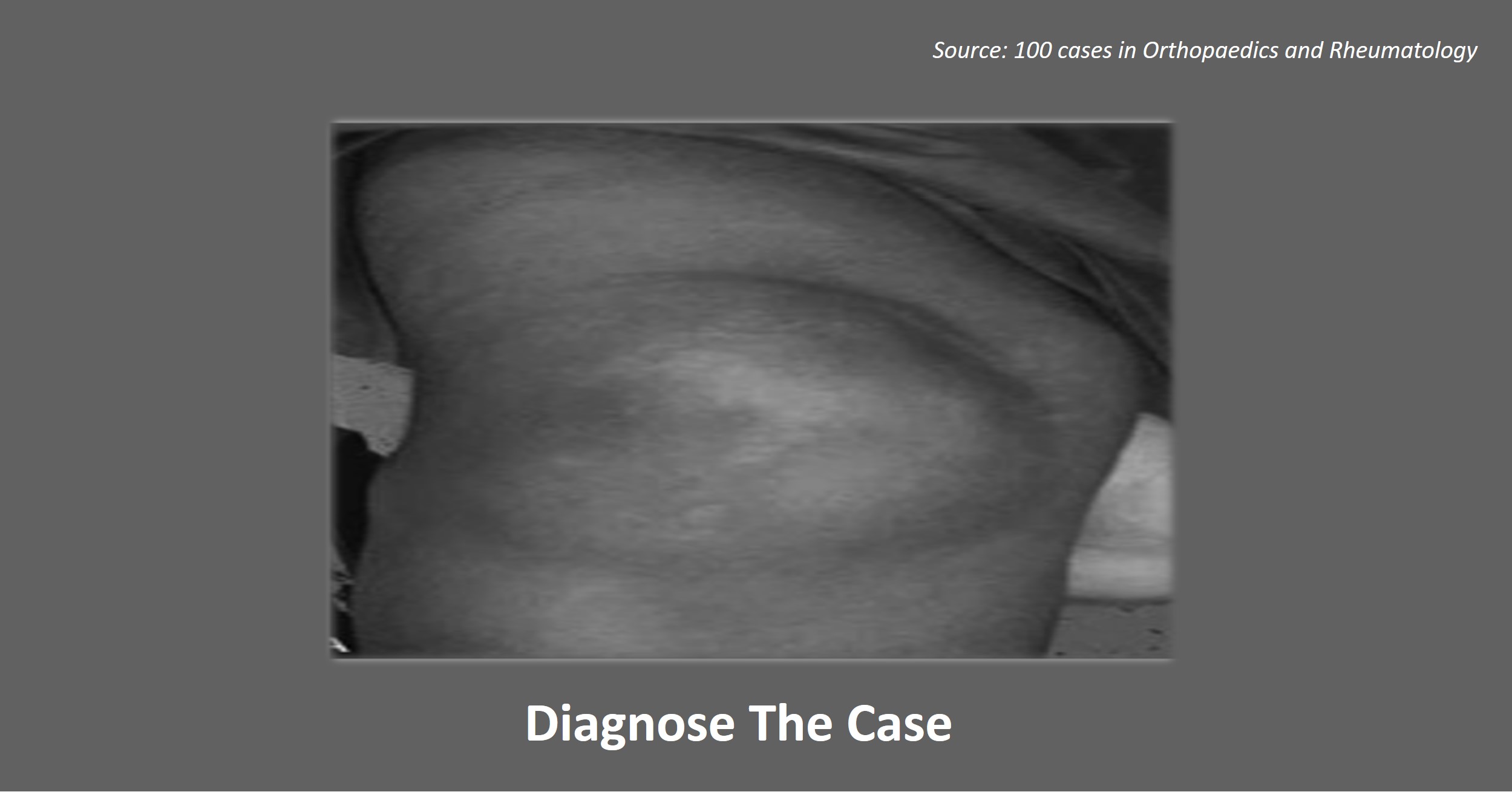 Knee Pain in a Young Boy with a History of Multiple Blood Transfusions