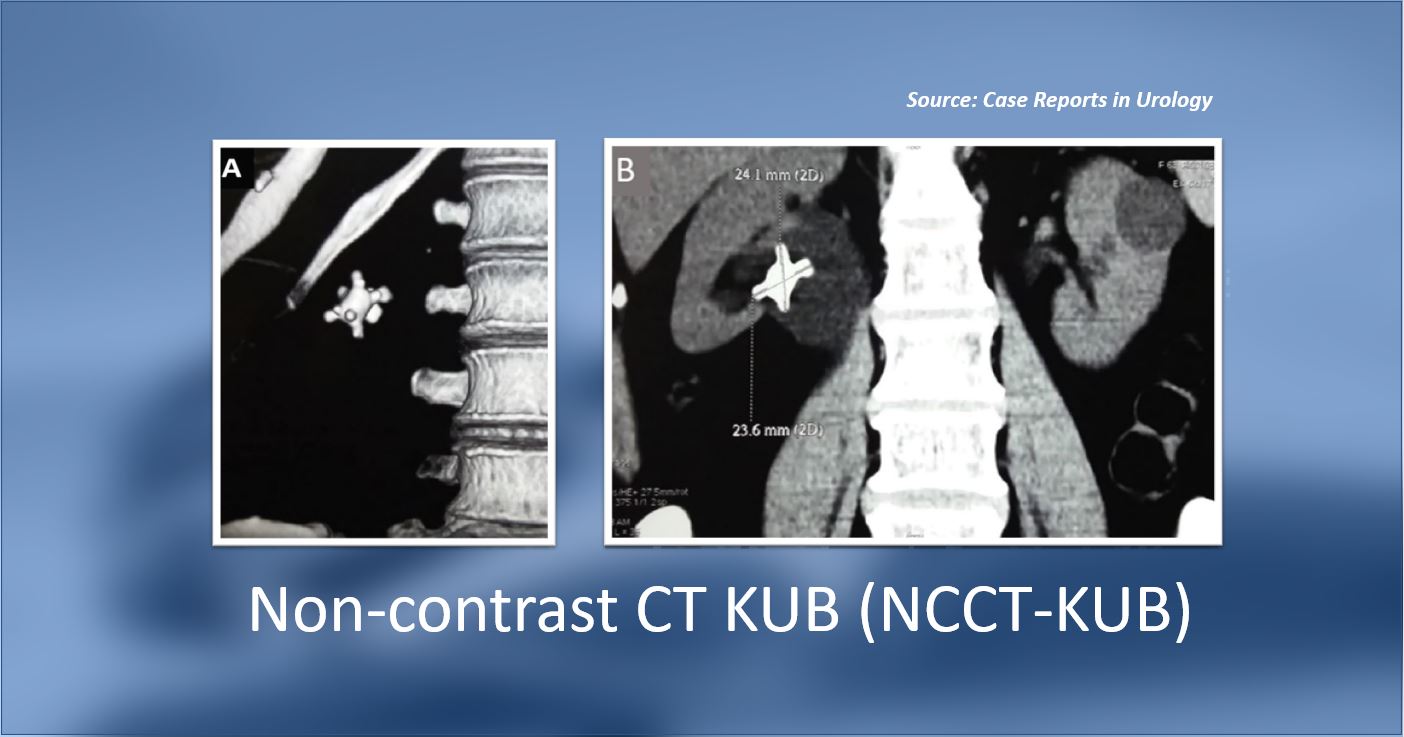 An Elderly Patient with Intermittent Hematuria