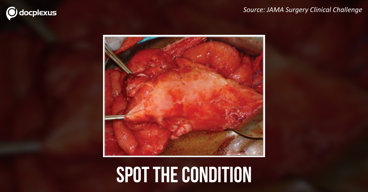 Case of a Man with Epigastric Abdominal Pain, Anorexia, and Weight Loss Post Laparotomy