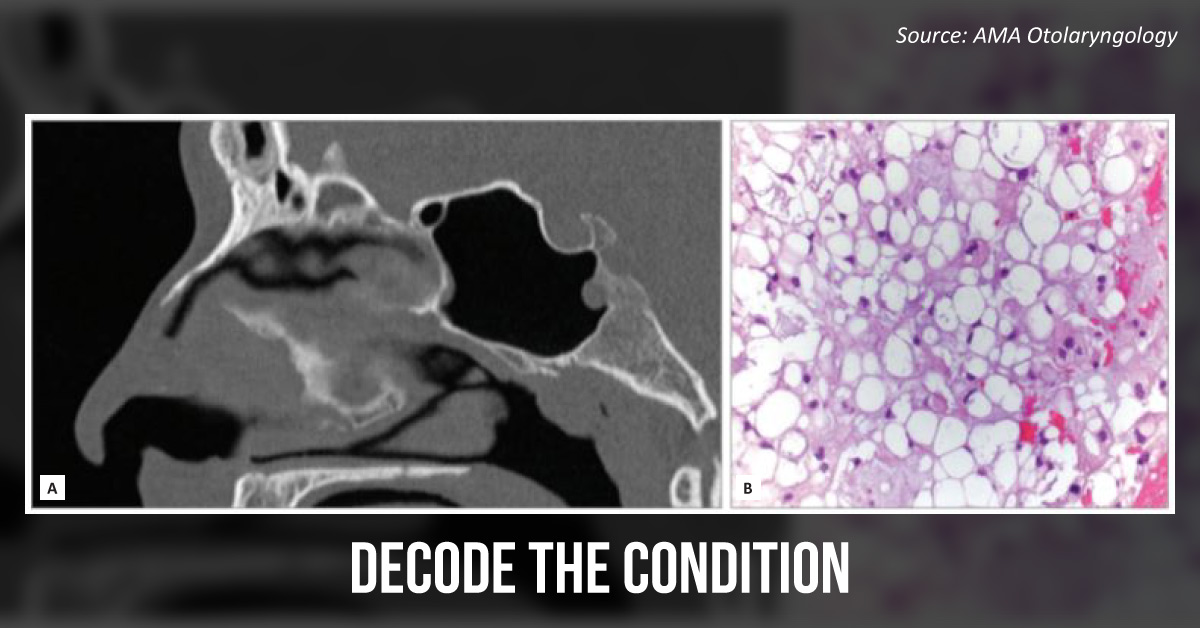 Soap-bubble Appearance of Cells Behind the Sphenoid Sinus - What's Your Diagnosis?