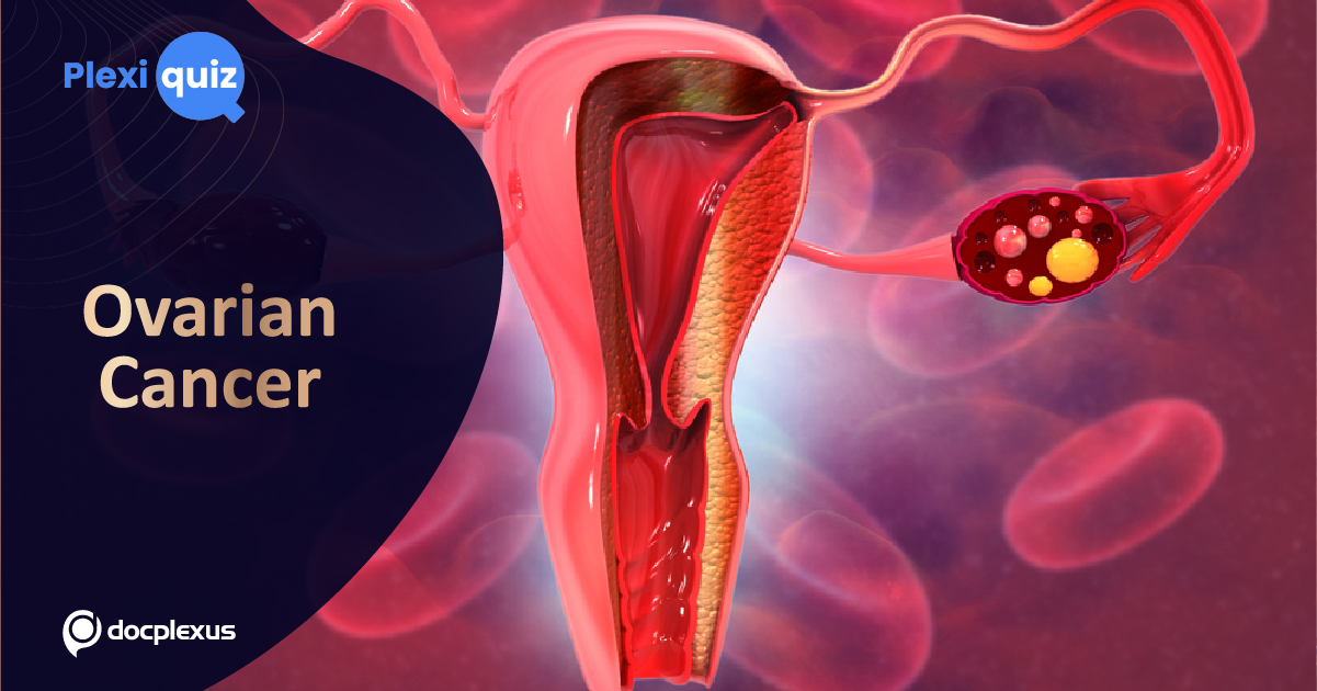 Ace The Quiz On Ovarian Cancer