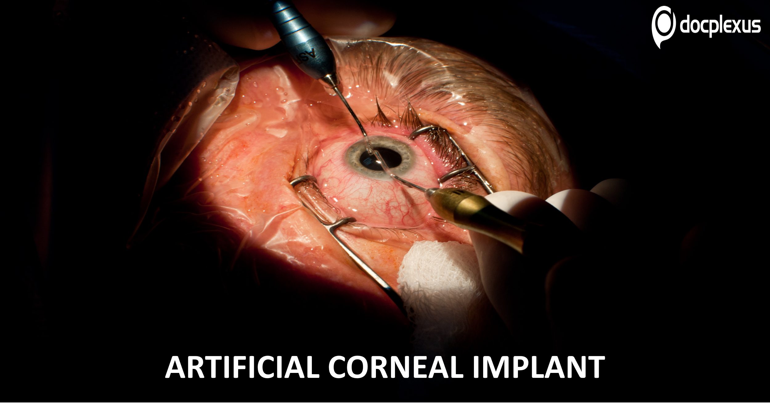 A New Artificial Corneal Implant