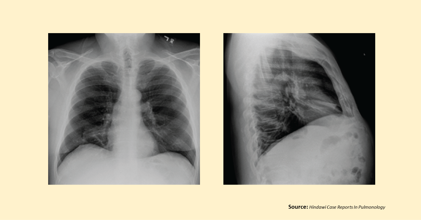 A Rare Case Of Pulmonary Disease