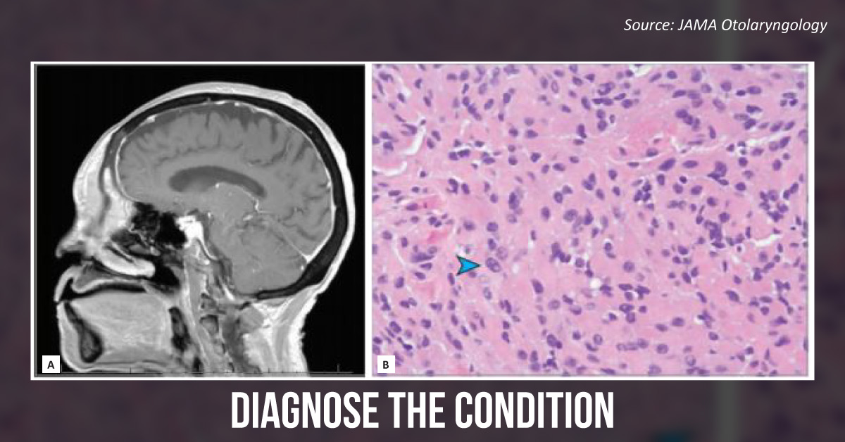 An Elderly Women With A History of Prolong Frontal Swelling