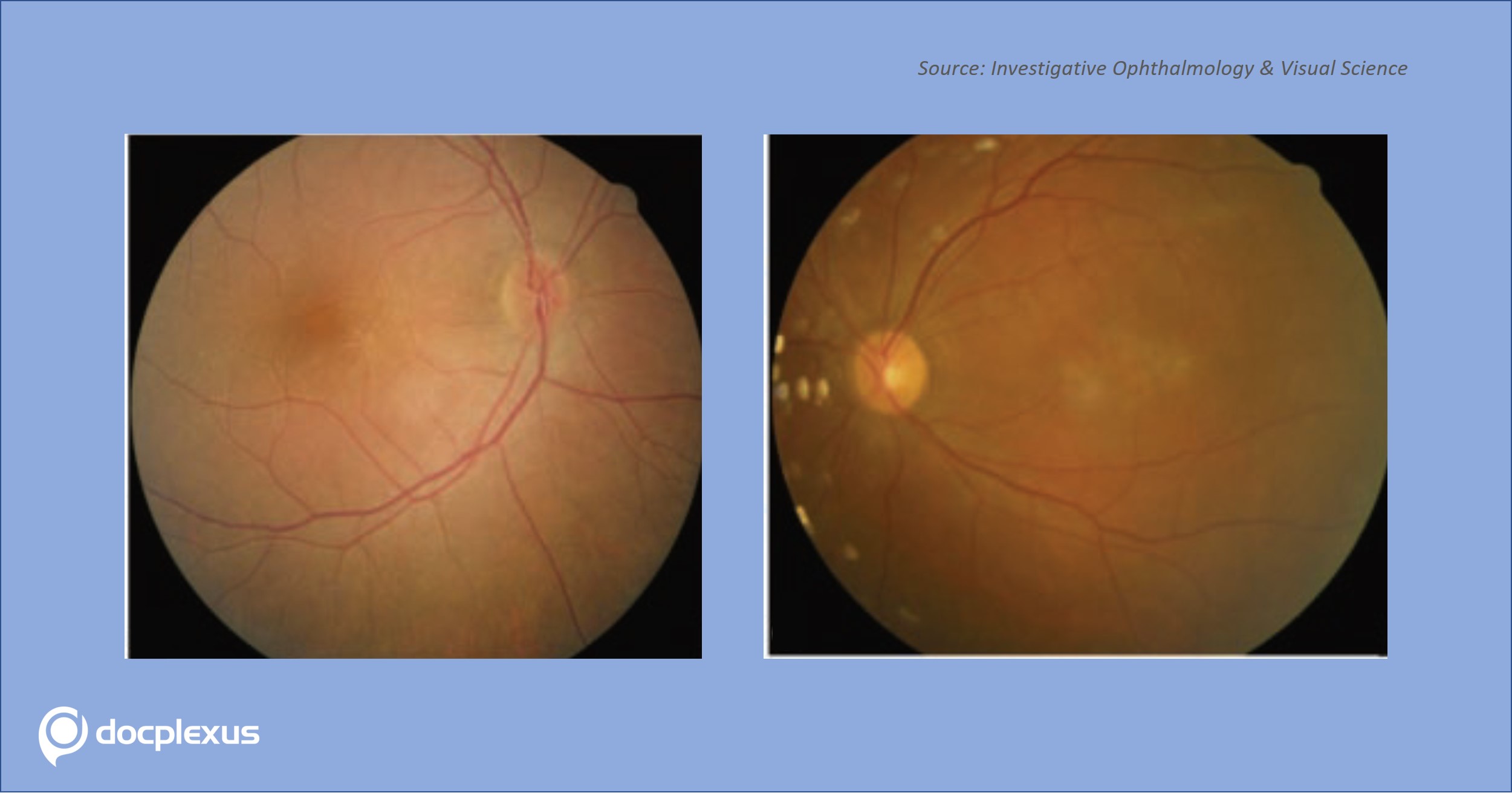 Leber’s Congenital Amaurosis – A Rare Ophthalmological Condition