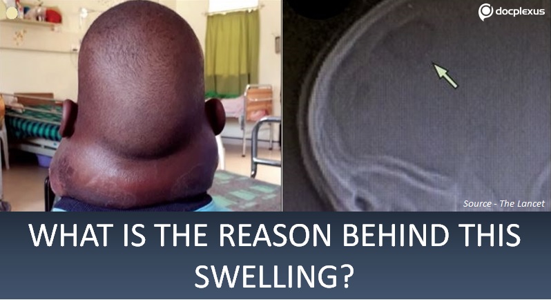 Diagnose This Rare Case of Progressive Neck Swelling