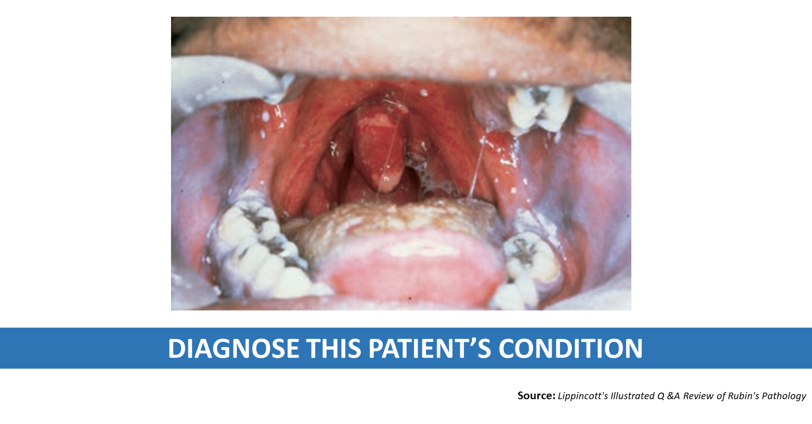 A Case of a White Patch on the Tongue