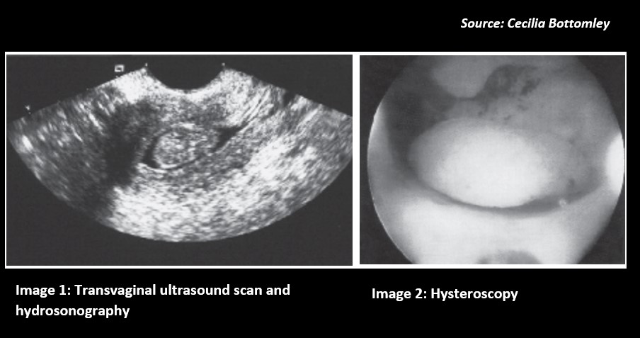 A Woman with Complaints of Intermenstrual Bleeding