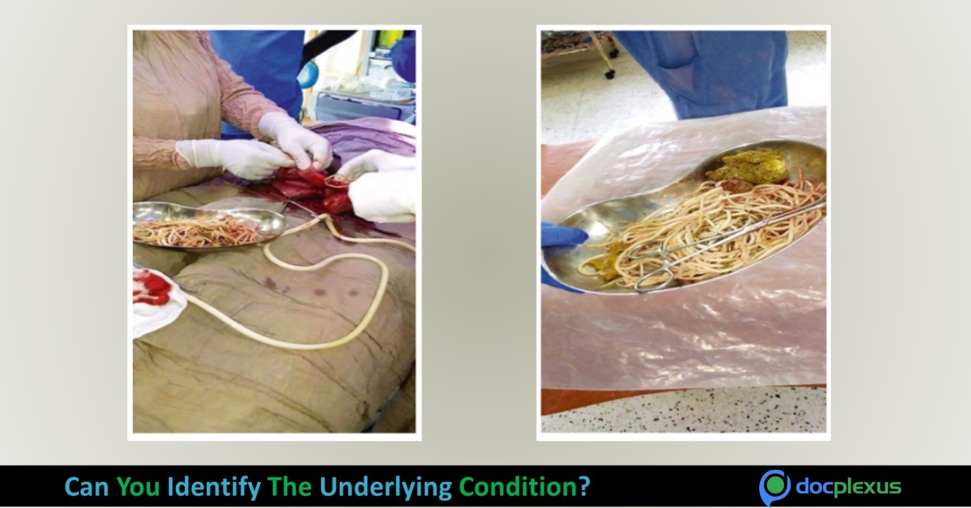 What is the Reason Behind the GI Manifestations in This 4-Year-old?