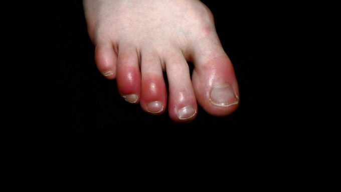 Covid Toe, Rashes And Covid Tongue: Lesser-known Symptoms That Could Be Linked To Coronavirus
