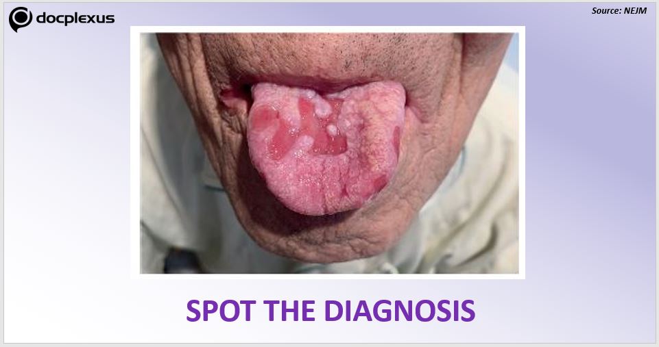 Diagnose the condition of Painful Tongue Lesion in an Elderly