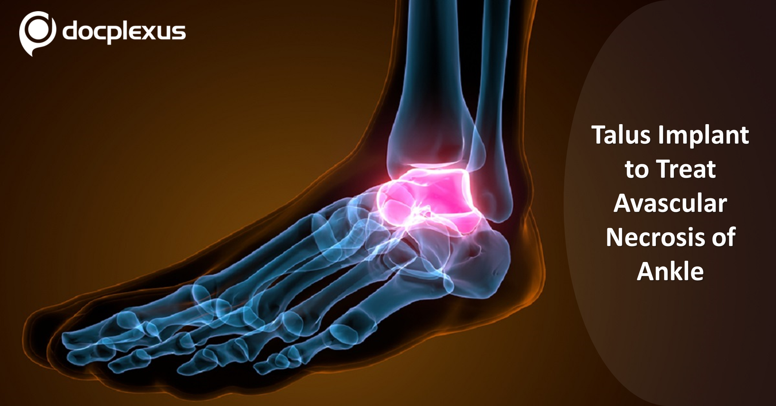 First-of-its-kind Talus Bone Implant to Treat Avascular Necrosis
