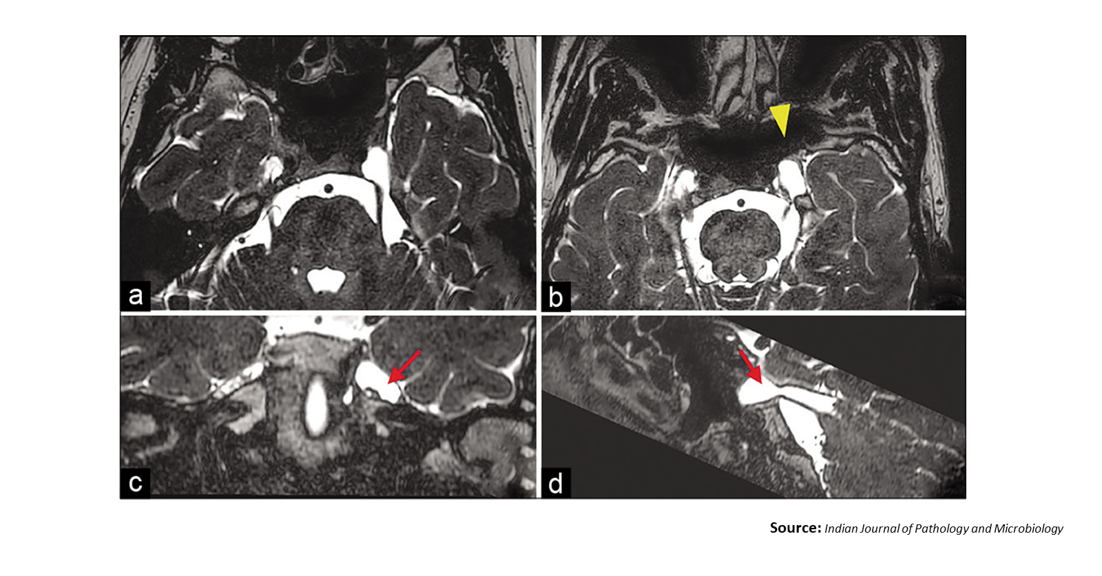 A Rare Case of Facial Pain in Adult