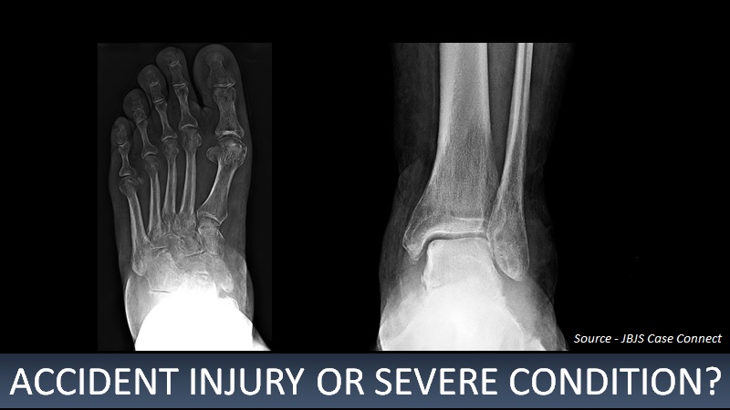 A Motor Vehicle Accident Leading to a Severe Condition