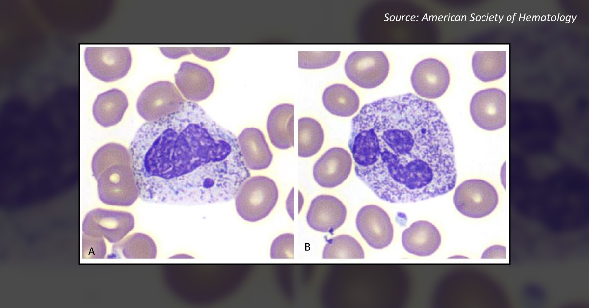 Abnormal Spots in the Blood Smear of a COVID-19 Patient