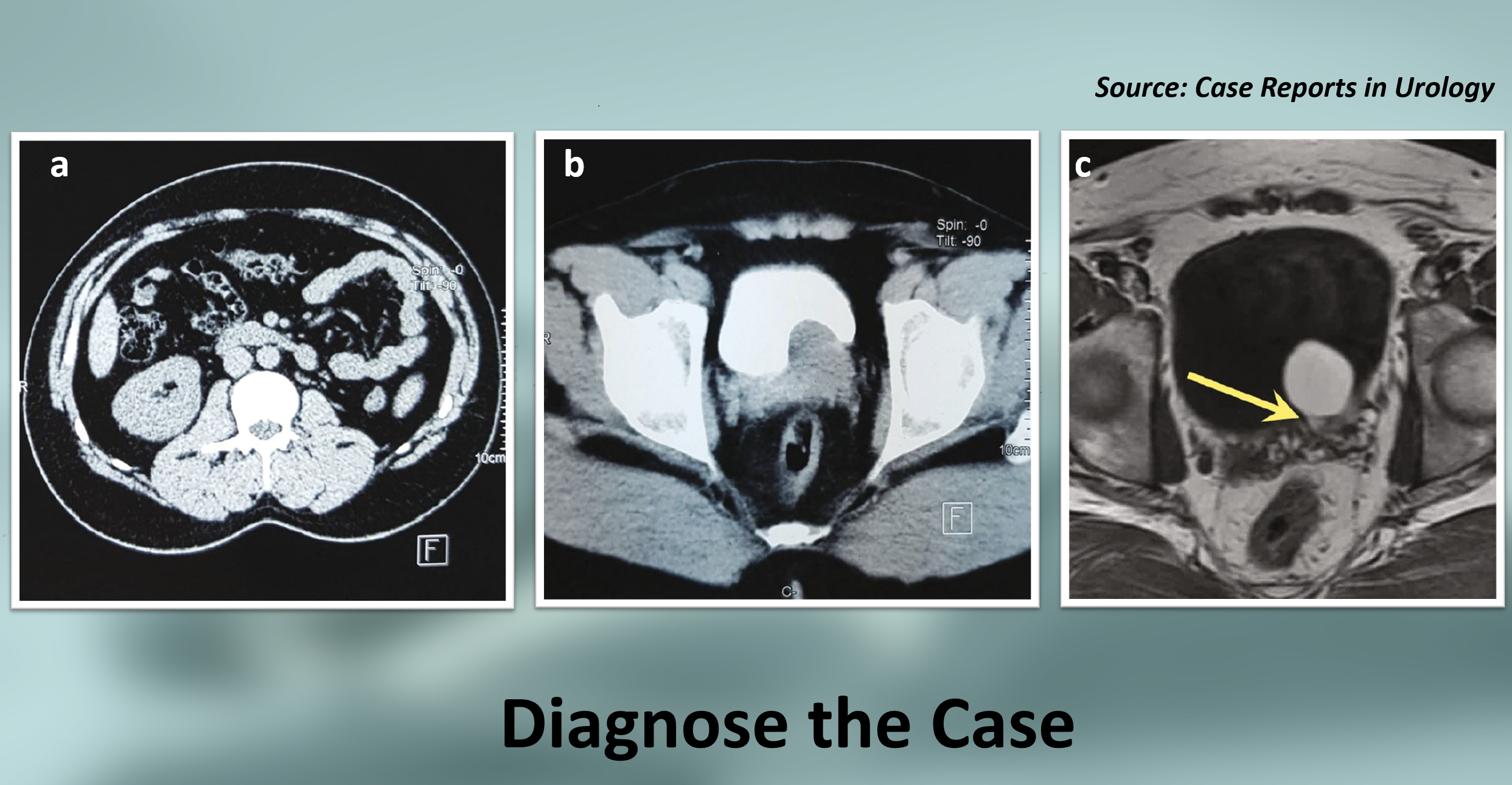 A Rare Case of Recurrent Dysuria with Hematospermia