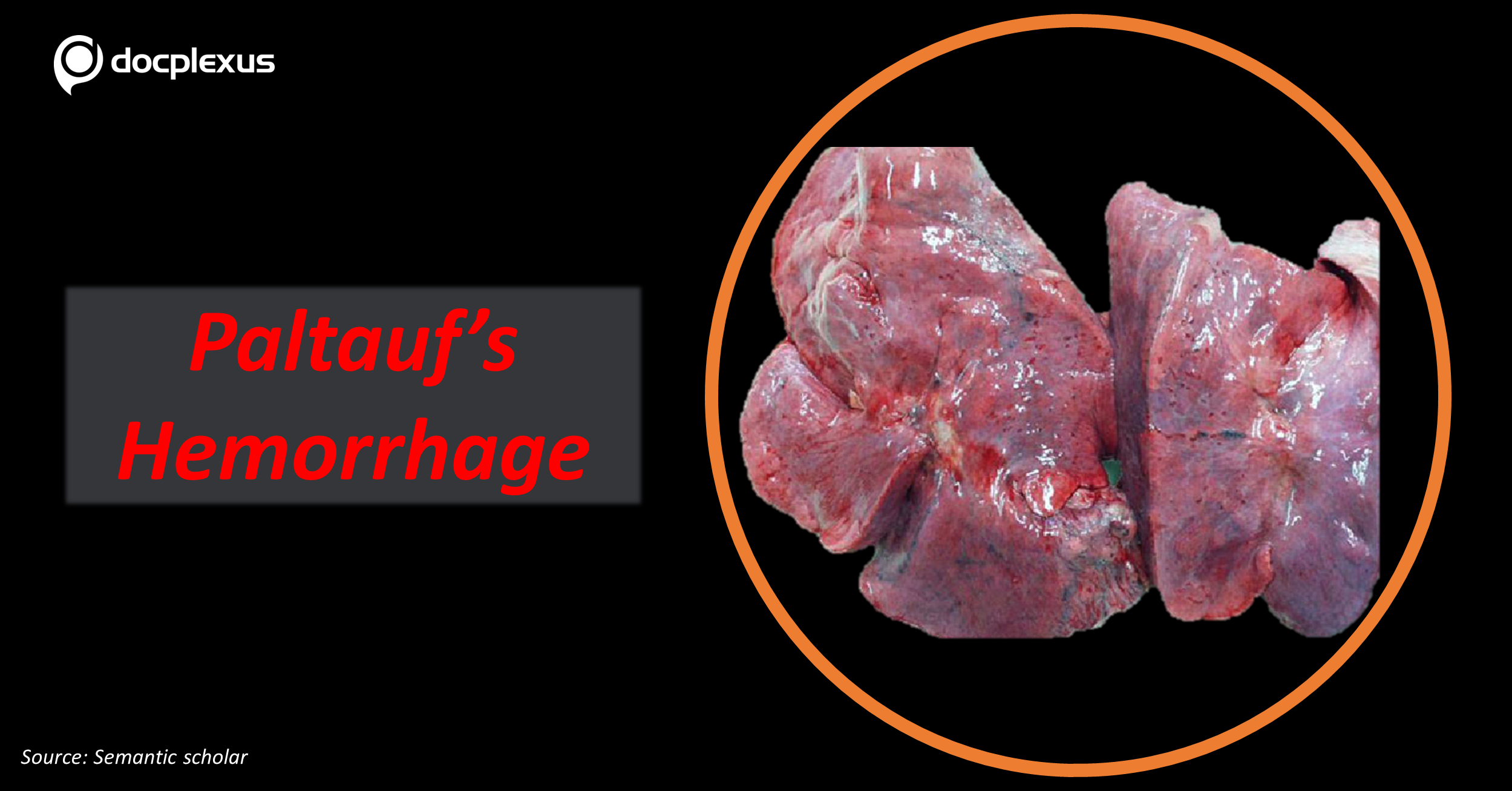 When is Paltauf’s Hemorrhage Commonly Observed?