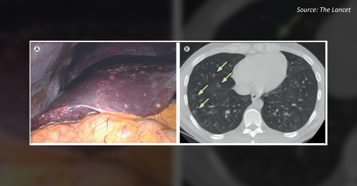 A Case of Abdominal Pain and Marked Leucocytosis