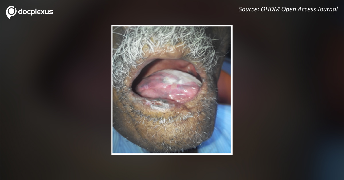 Diagnose This Case of Lip Lesion