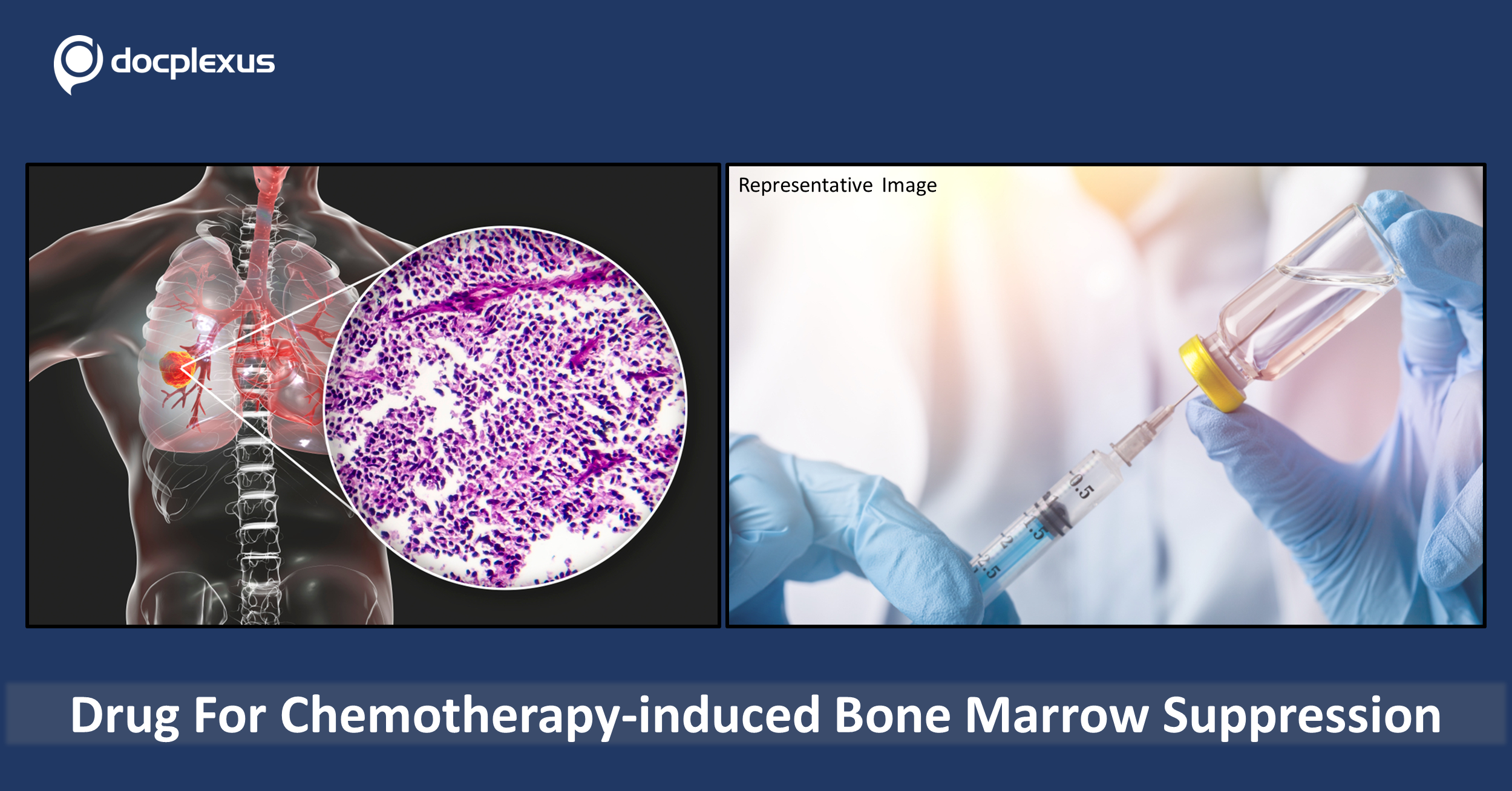 USFDA Approves Drug for Chemotherapy-induced Bone Marrow Suppression