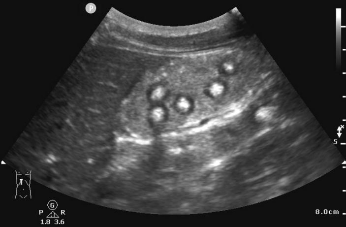 'Marble-like Objects' Found In Teen's Stomach; Doctors Shocked