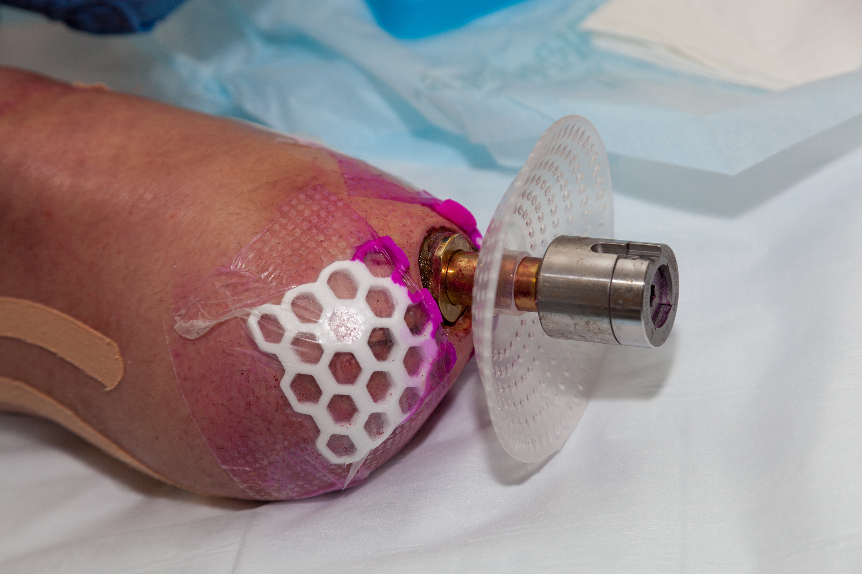 New Amputation Surgery for Better Prosthetic Control