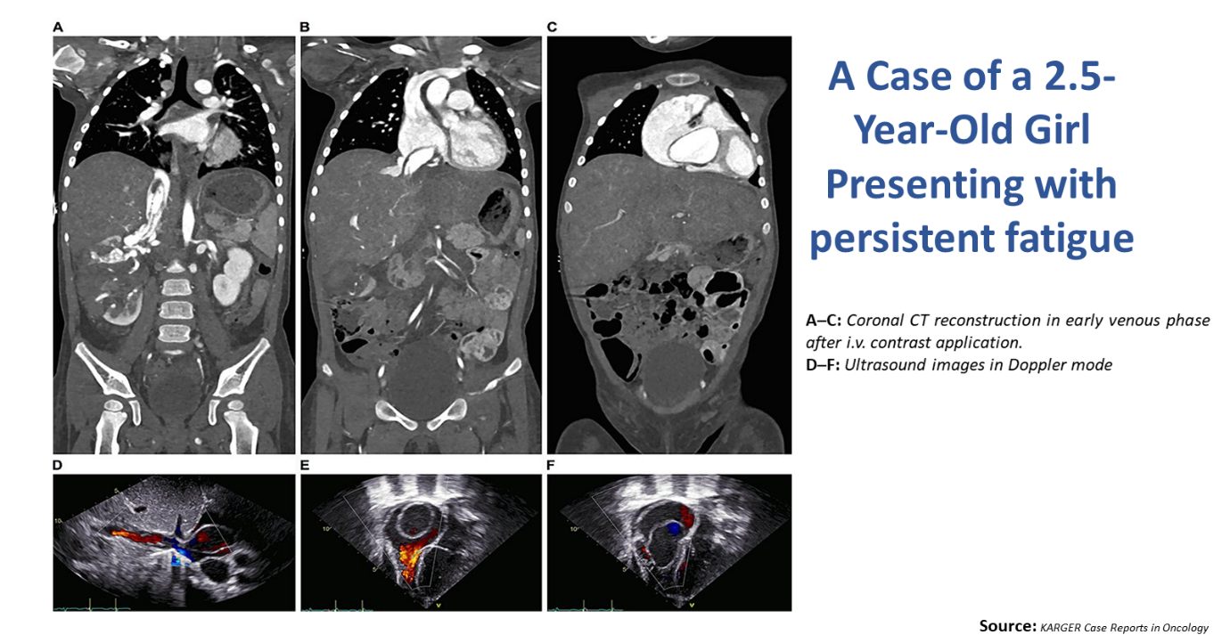 A Case of a 2.5-year-old Girl Presenting with Persistent Fatigue