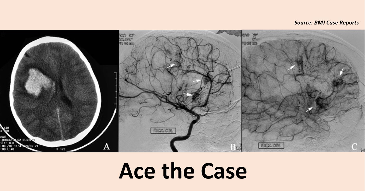 A Rare Case of Stroke and Seizures in a Young Boy– What’s Your Diagnosis?