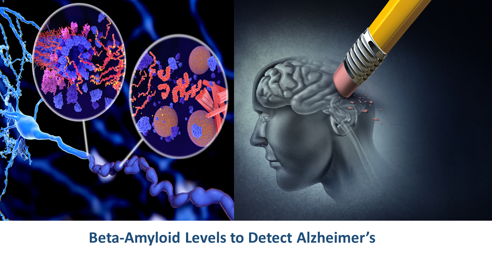 Detecting Alzheimer’s Through Beta-Amyloid Levels in the Blood